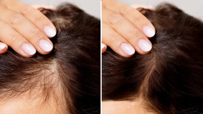 How to Regain Your Confidence with Proven Hair Loss Treatment?