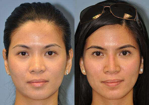 How to Choose the Right Non-Surgical Nose Job Provider?